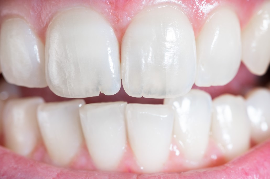 How Often Do Dental Veneers Need to Be Replaced 2024 Guide Bare